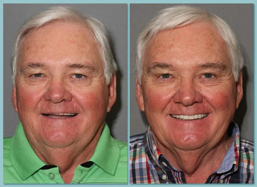 Before and After Dental Implants: Transformative Smile Restoration