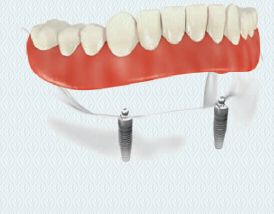 image_dental_implants_nj_1