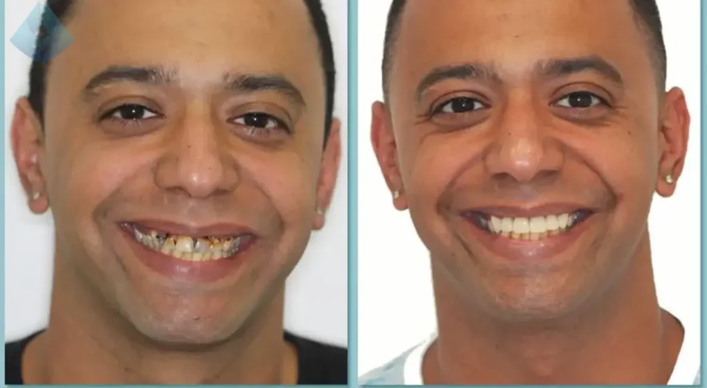 The Telltale Signs of an Aging Smile