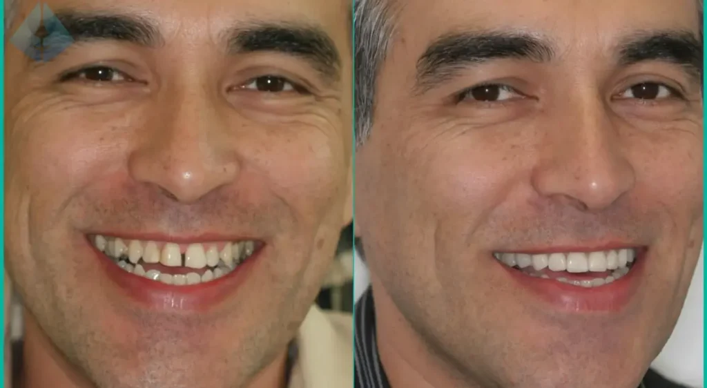 What Exactly is a No-Braces Smile Makeover in NJ