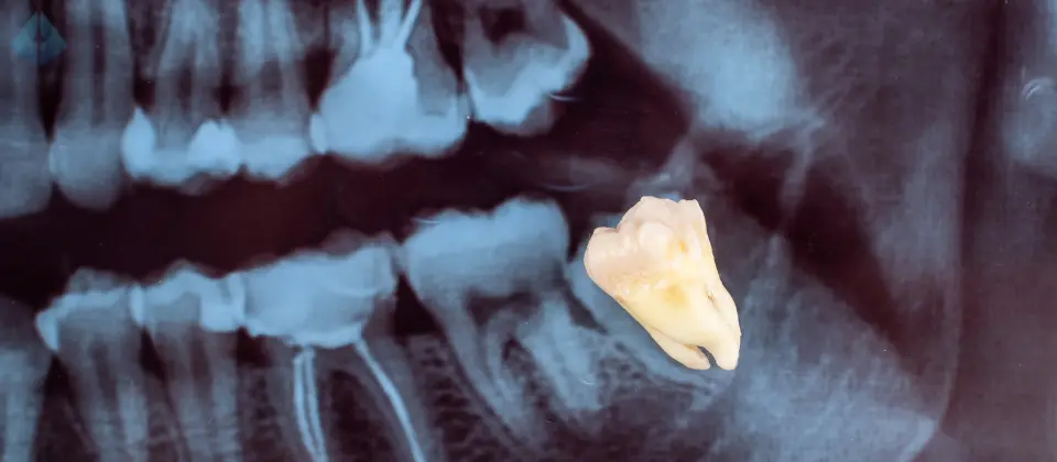 Wisdom Teeth Complications NJ | Dr. Carranza, Westfield