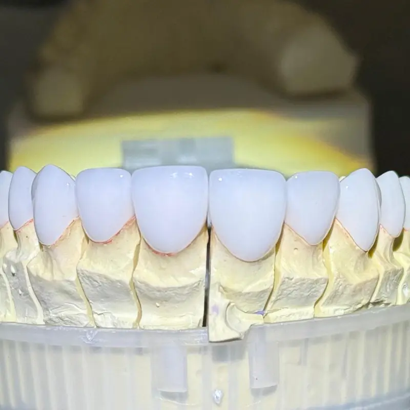Close-up front view of custom-crafted porcelain veneers on a dental model at Smile Design NJ