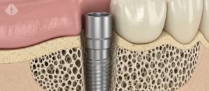 Close up diagram showing successful Dental Implant Osseointegration within the jawbone