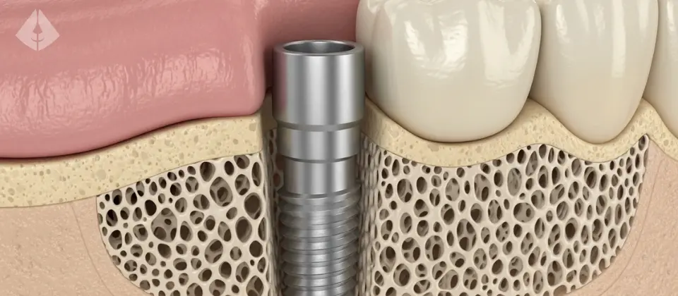 Close up diagram showing successful Dental Implant Osseointegration within the jawbone
