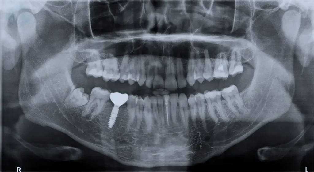 Digital X-ray confirming successful Dental Implant Osseointegration